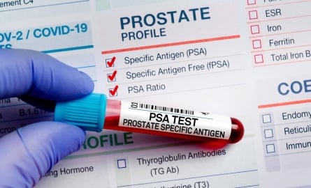 My PSA is High: Does That Mean I Have Prostate Cancer?