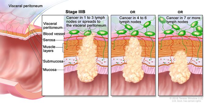 stage 3b colon and rectal cancer