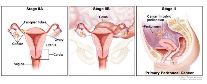 stage 2 ovarian cancer 2a 2b 2c ovarian cancer stage