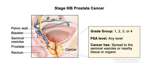 Prostate Cancer Stage 3b