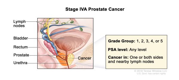 Prostate Cancer Stage 4A