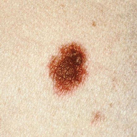 pinpoint red dots on skin colon cancer