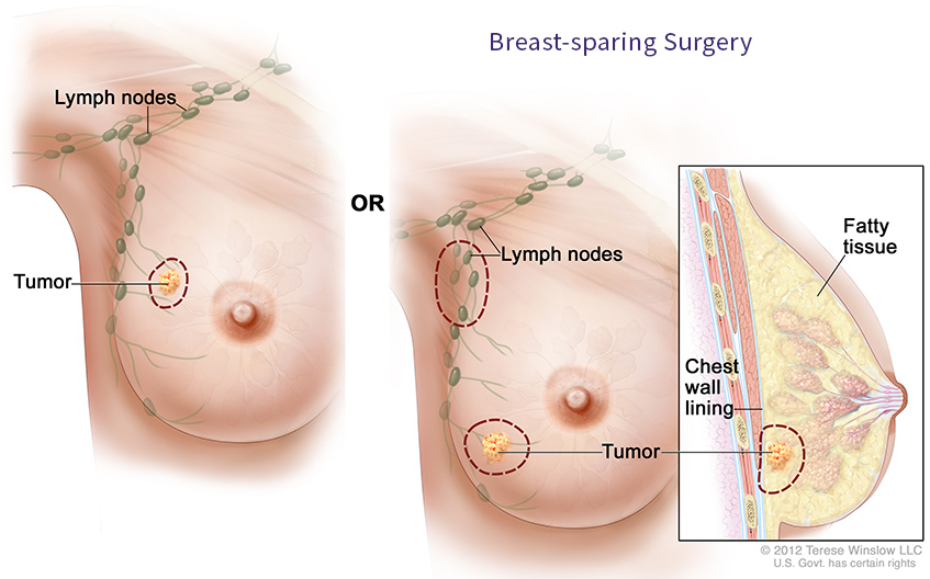 No lump, no tumor, the breast cancer disguised as a skin rash